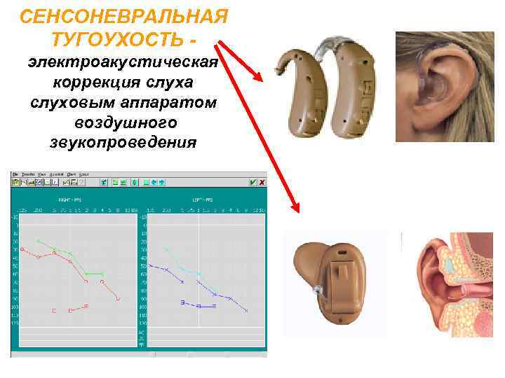 СЕНСОНЕВРАЛЬНАЯ ТУГОУХОСТЬ электроакустическая коррекция слуха слуховым аппаратом воздушного звукопроведения 