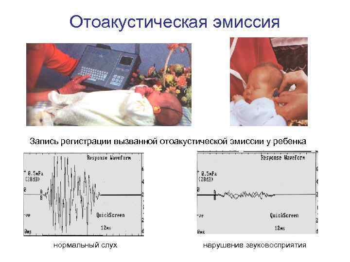 Отоакустическая эмиссия Запись регистрации вызванной отоакустической эмиссии у ребенка нормальный слух нарушение звуковосприятия 