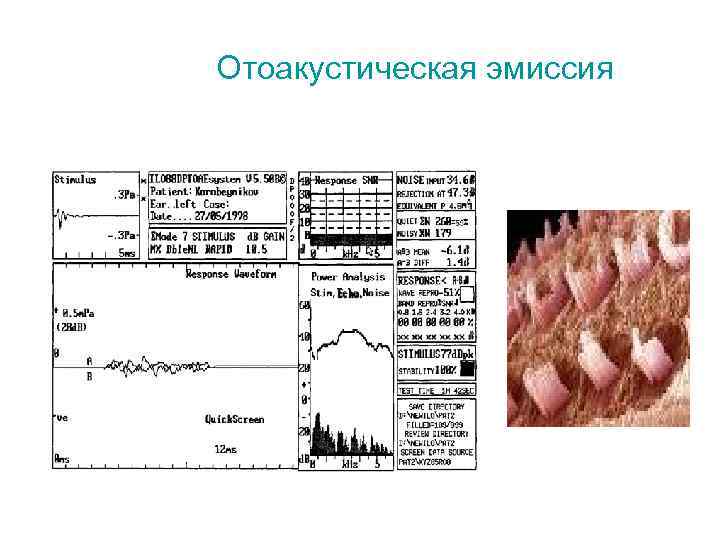 Отоакустическая эмиссия 