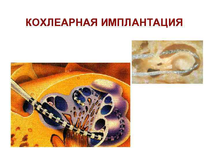КОХЛЕАРНАЯ ИМПЛАНТАЦИЯ 