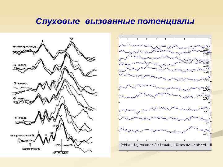 Регистрация слуховых вызванных потенциалов