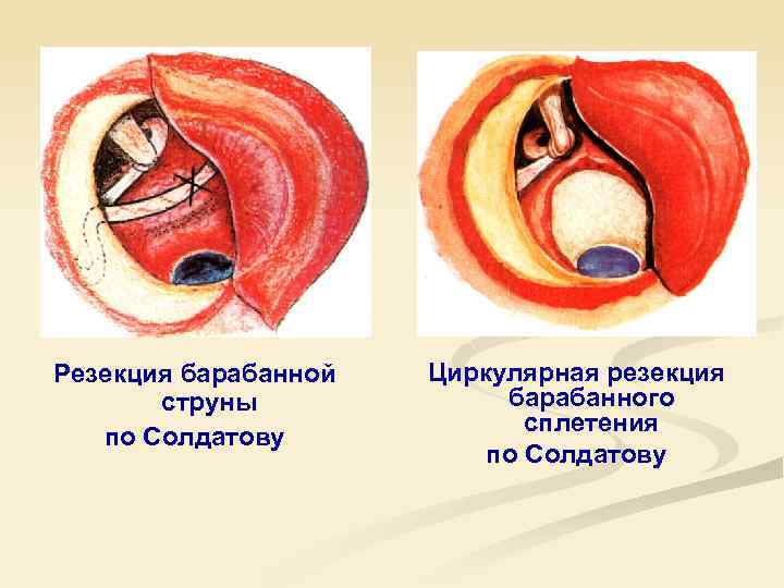 Резекция барабанной струны по Солдатову Циркулярная резекция барабанного сплетения по Солдатову 