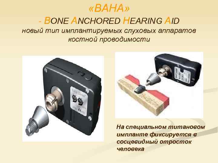  «BAHA» - ВОNЕ ANCHORED HEARING AID новый тип имплантируемых слуховых аппаратов костной проводимости