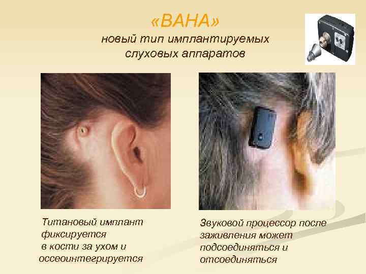  «BAHA» новый тип имплантируемых слуховых аппаратов Титановый имплант фиксируется в кости за ухом