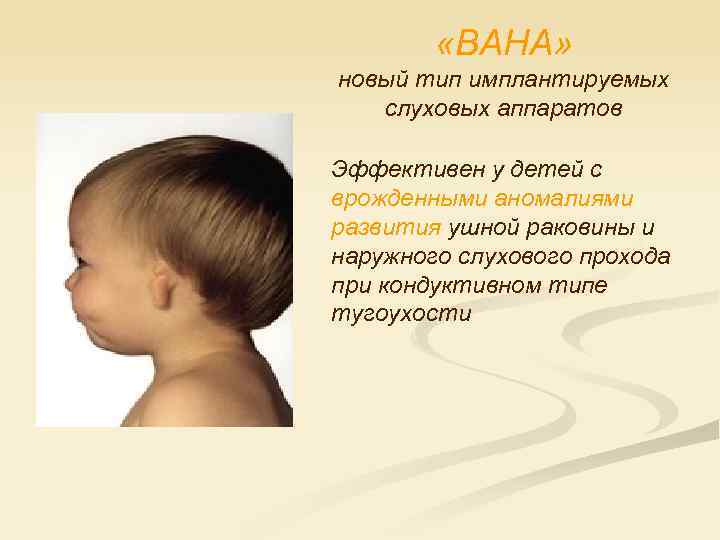  «BAHA» новый тип имплантируемых слуховых аппаратов Эффективен у детей с врожденными аномалиями развития