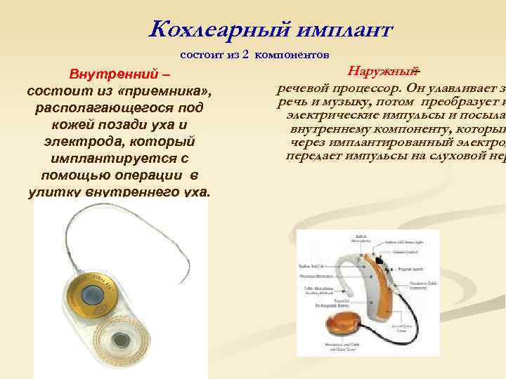 Кохлеарный имплант состоит из 2 компонентов Внутренний – состоит из «приемника» , располагающегося под