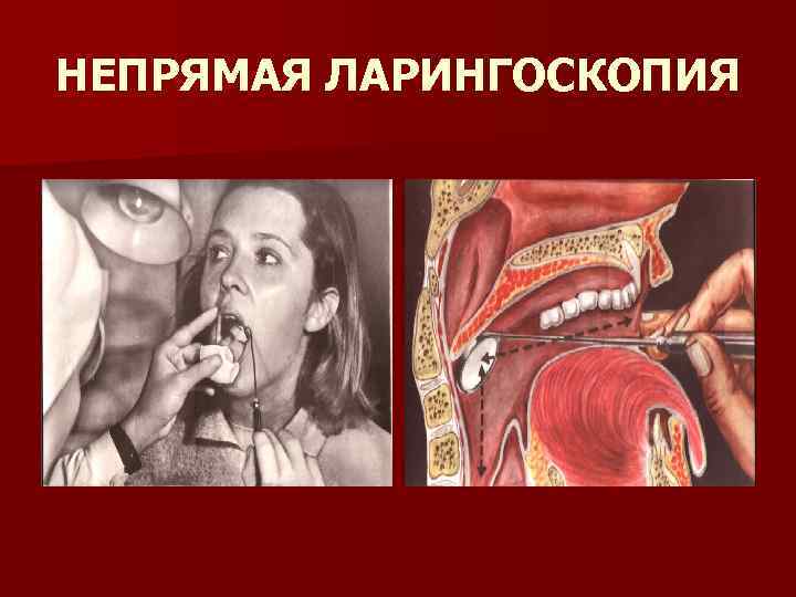 НЕПРЯМАЯ ЛАРИНГОСКОПИЯ 