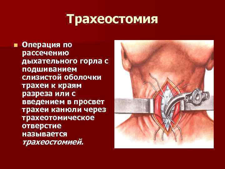 Трахеостомия n Операция по рассечению дыхательного горла с подшиванием слизистой оболочки трахеи к краям