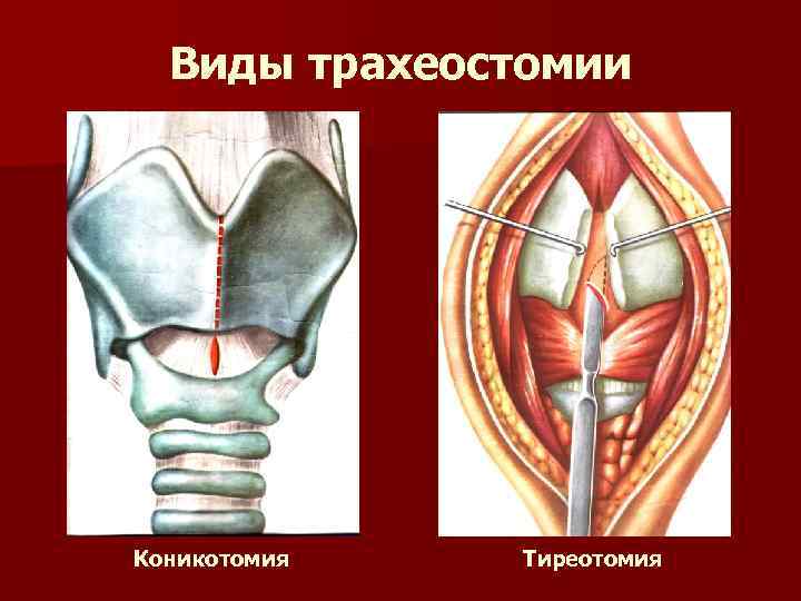 Ошибки трахеостомии