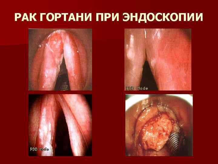 РАК ГОРТАНИ ПРИ ЭНДОСКОПИИ 