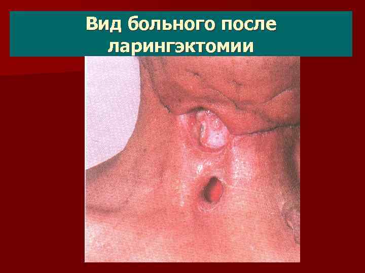 Вид больного после ларингэктомии 