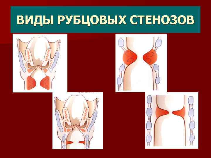 ВИДЫ РУБЦОВЫХ СТЕНОЗОВ 