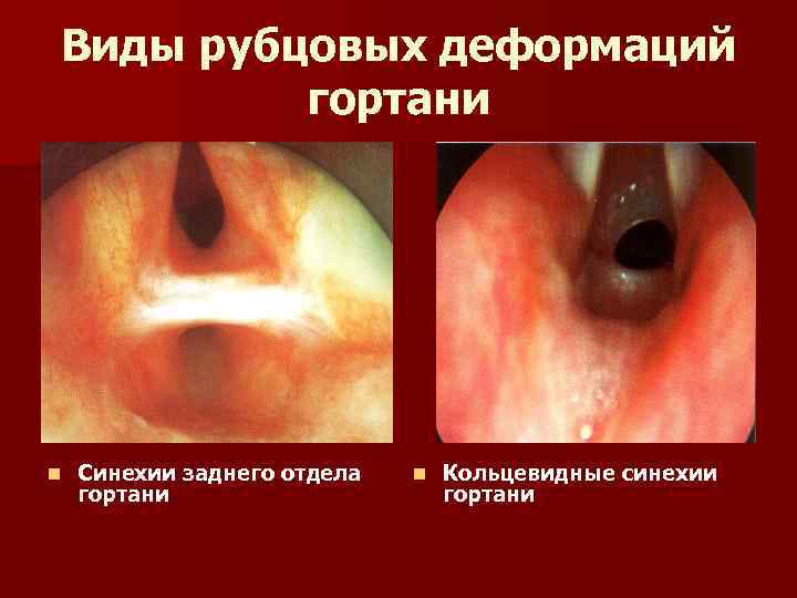 Виды рубцовых деформаций гортани n Синехии заднего отдела гортани n Кольцевидные синехии гортани 