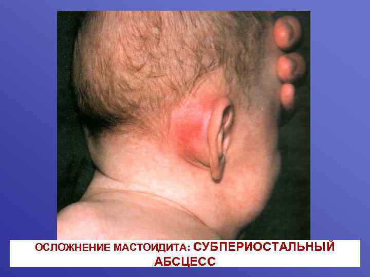 ОСЛОЖНЕНИЕ МАСТОИДИТА: СУБПЕРИОСТАЛЬНЫЙ АБСЦЕСС 