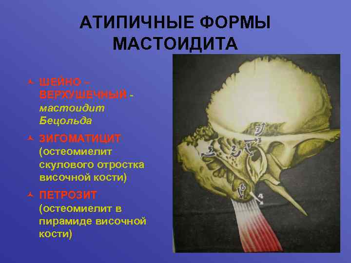 АТИПИЧНЫЕ ФОРМЫ МАСТОИДИТА © ШЕЙНО – ВЕРХУШЕЧНЫЙ мастоидит Бецольда © ЗИГОМАТИЦИТ (остеомиелит скулового отростка