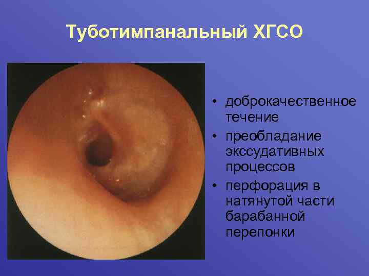 Туботимпанальный ХГСО • доброкачественное течение • преобладание экссудативных процессов • перфорация в натянутой части