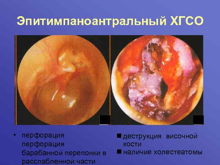 Эпитимпаноантральный ХГСО • перфорация барабанной перепонки в расслабленной части n деструкция височной кости n