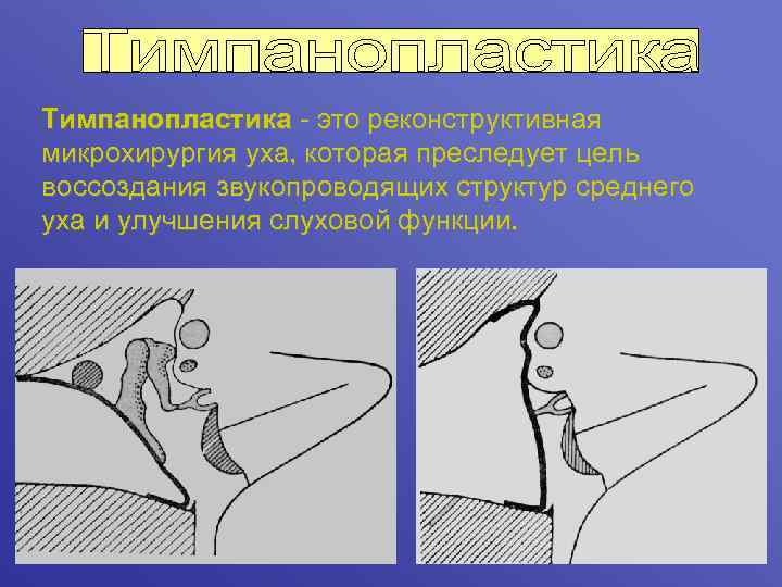 Тимпанопластика - это реконструктивная микрохирургия уха, которая преследует цель воссоздания звукопроводящих структур среднего уха