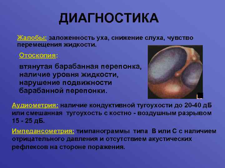 ДИАГНОСТИКА Жалобы: заложенность уха, снижение слуха, чувство перемещения жидкости. Отоскопия: втянутая барабанная перепонка, наличие