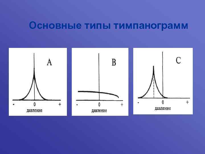 Основные типы тимпанограмм 