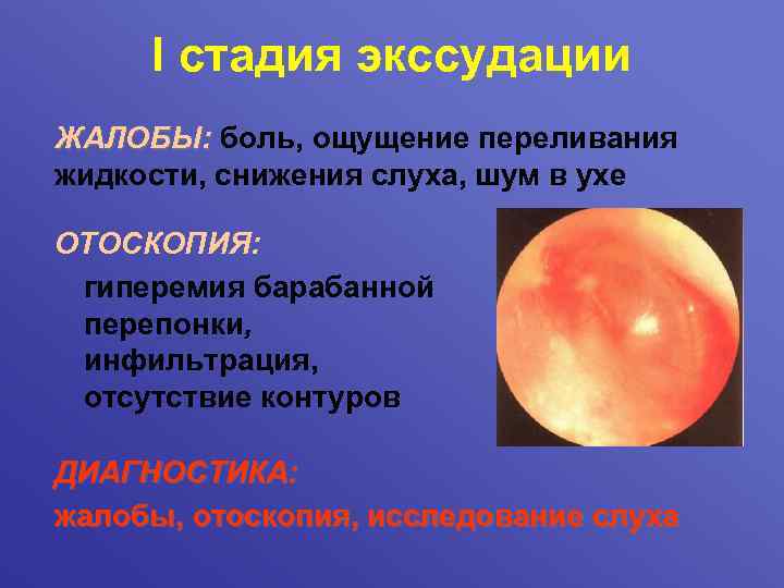 I стадия экссудации ЖАЛОБЫ: боль, ощущение переливания жидкости, снижения слуха, шум в ухе ОТОСКОПИЯ: