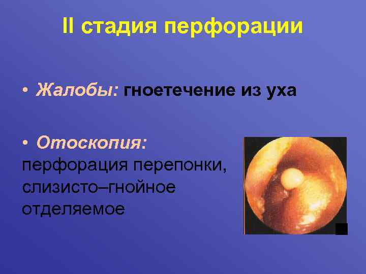 II стадия перфорации • Жалобы: гноетечение из уха • Отоскопия: перфорация перепонки, слизисто–гнойное отделяемое