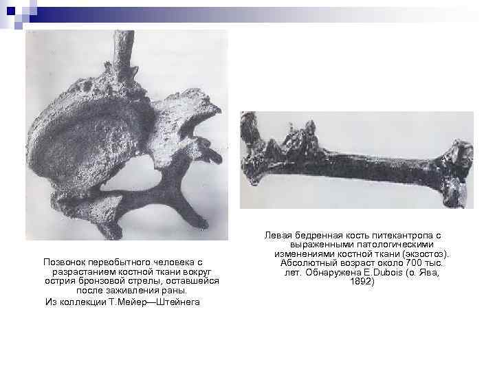        Левая бедренная кость питекантропа с  