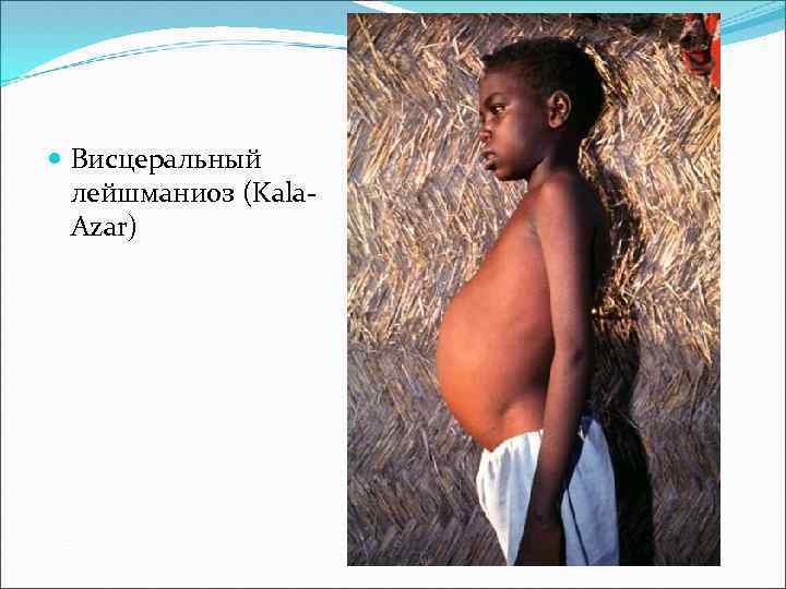  Висцеральный лейшманиоз (Kala. Azar) 