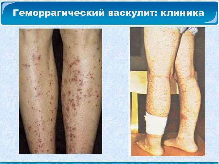 Геморрагический васкулит: клиника 