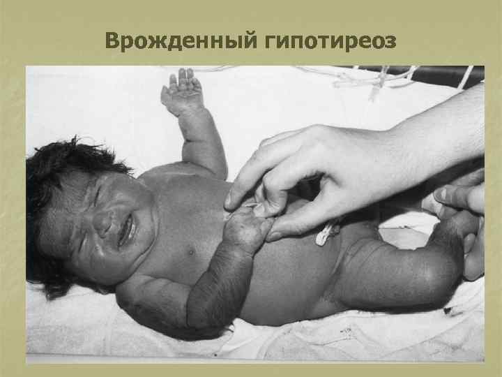 Врожденный гипотиреоз 