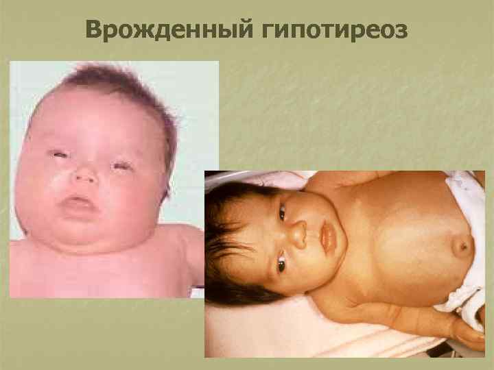 Врожденный гипотиреоз 