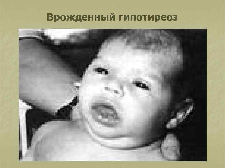 Врожденный гипотиреоз 
