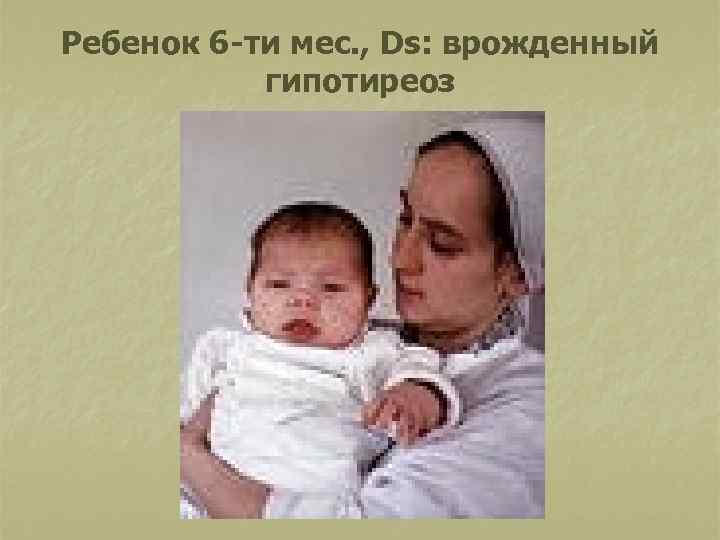 Ребенок 6 -ти мес. , Ds: врожденный гипотиреоз 