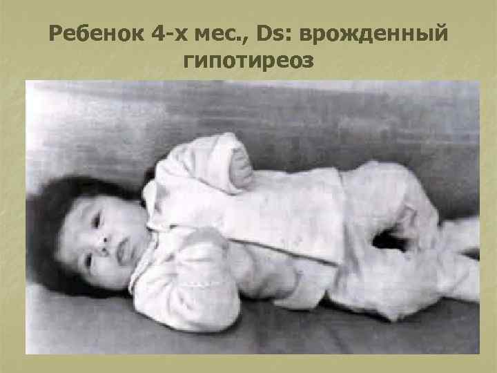 Ребенок 4 -х мес. , Ds: врожденный гипотиреоз 
