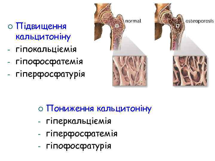 ¡ - Підвищення кальцитоніну гіпокальціємія гіпофосфатемія гіперфосфатурія ¡ - Пониження кальцитоніну гіперкальціємія гіперфосфатемія гіпофосфатурія