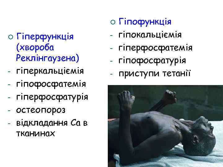¡ ¡ - Гіперфункція (хвороба Реклінгаузена) гіперкальціємія гіпофосфатемія гіперфосфатурія остеопороз відкладання Са в тканинах