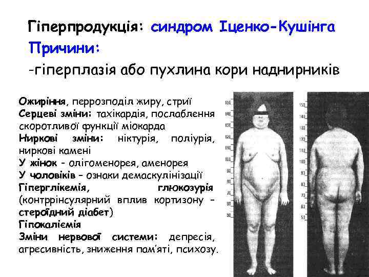 Гіперпродукція: синдром Іценко-Кушінга Причини: -гіперплазія або пухлина кори наднирників Ожиріння, перрозподіл жиру, стриї Серцеві
