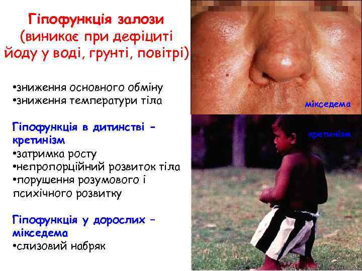 Гіпофункція залози (виникає при дефіциті йоду у воді, грунті, повітрі) • зниження основного обміну