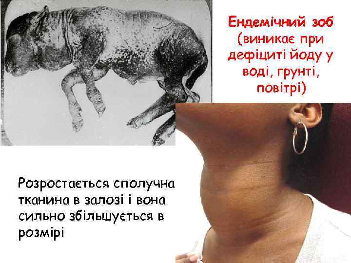 Ендемічний зоб (виникає при дефіциті йоду у воді, грунті, повітрі) Розростається сполучна тканина в