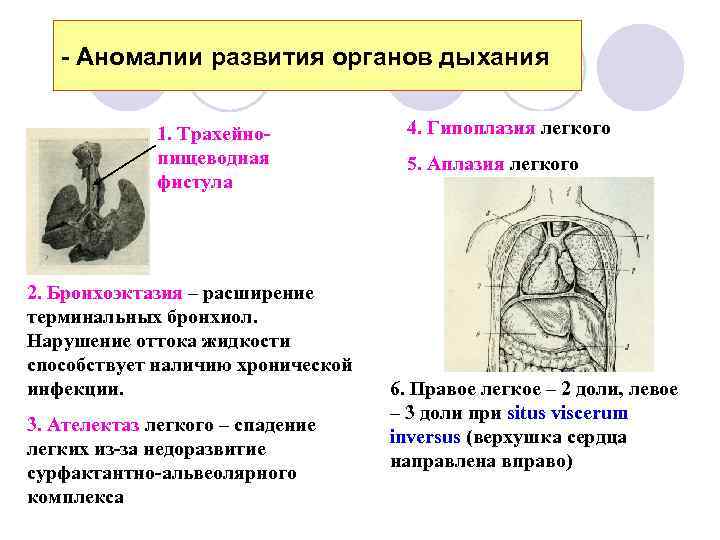 - Аномалии развития органов дыхания 1. Трахейнопищеводная фистула 2. Бронхоэктазия – расширение терминальных бронхиол.