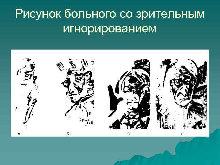 Рисунок больного со зрительным игнорированием 