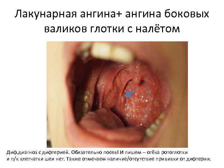  Лакунарная ангина+ ангина боковых валиков глотки с налётом Диф. диагноз с дифтерией. Обязательно