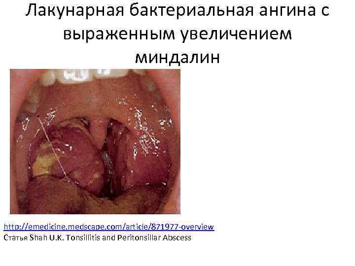  Лакунарная бактериальная ангина с выраженным увеличением миндалин http: //emedicine. medscape. com/article/871977 -overview Статья