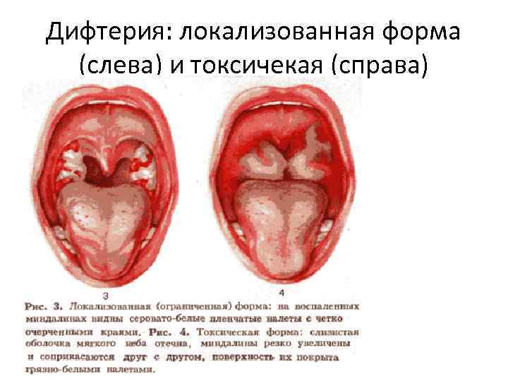 Дифтерия: локализованная форма (слева) и токсичекая (справа) 