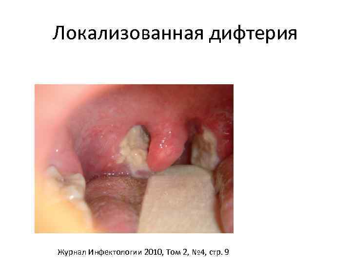 Локализованная дифтерия Журнал Инфектологии 2010, Том 2, № 4, стр. 9 