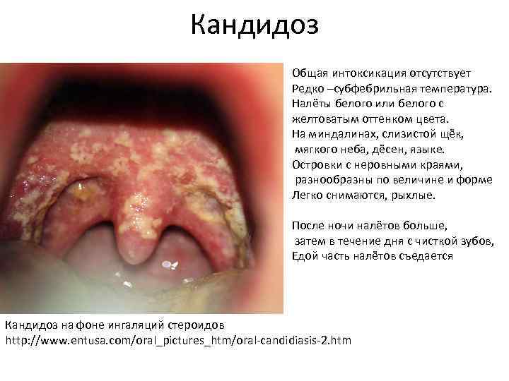  Кандидоз Общая интоксикация отсутствует Редко –субфебрильная температура. Налёты белого или белого с желтоватым
