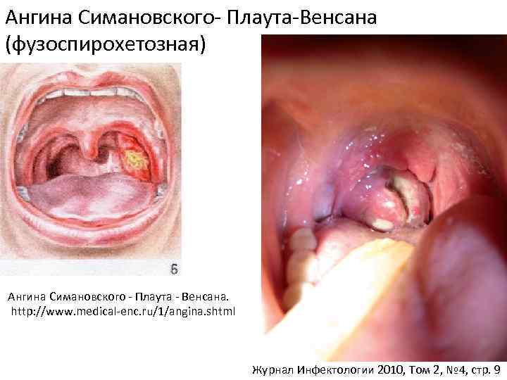 Ангина Симановского- Плаута-Венсана (фузоспирохетозная) Ангина Симановского - Плаута - Венсана. http: //www. medical-enc. ru/1/angina.