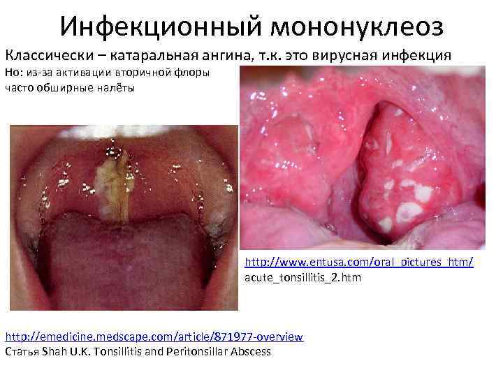  Инфекционный мононуклеоз Классически – катаральная ангина, т. к. это вирусная инфекция Но: из-за