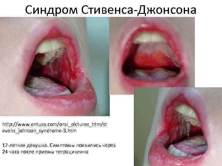  Синдром Стивенса-Джонсона http: //www. entusa. com/oral_pictures_htm/st evens_johnson_syndrome-3. htm 17 -летняя девушка. Симптомы появились