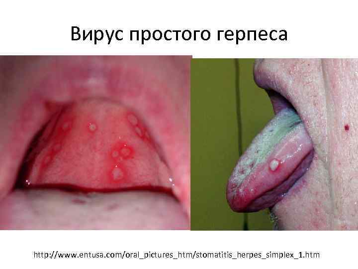  Вирус простого герпеса http: //www. entusa. com/oral_pictures_htm/stomatitis_herpes_simplex_1. htm 